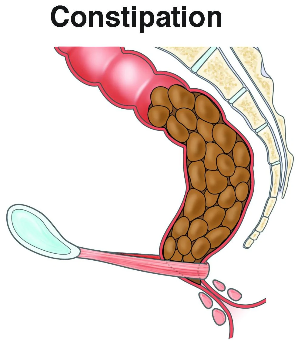 Constipation Management